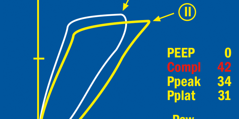 Pressure/Volume loop of a Laparoscopy