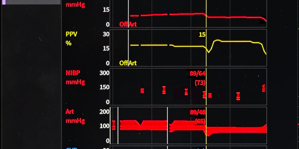: Sample of customized notification implementation for indicators of Hypovolemia combining Pulse or Systolic Pressure Variation (SPV/ PPV), Systolic BP (NIBP / ART) & Central Venous pressure (CPV) measurement thresholds. 