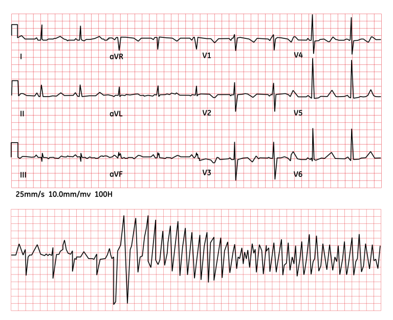 QT prolongation and TdP