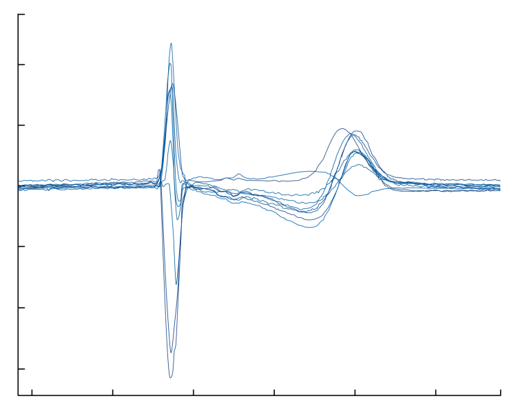 Overlay of different PQRST