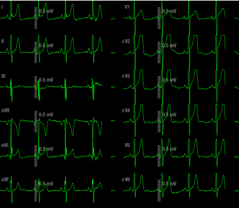 12 ECG waveforms in monitor screen