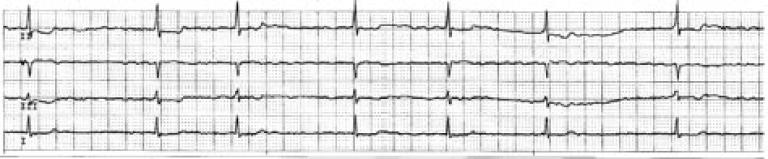 ECG showing atrial fibrillation