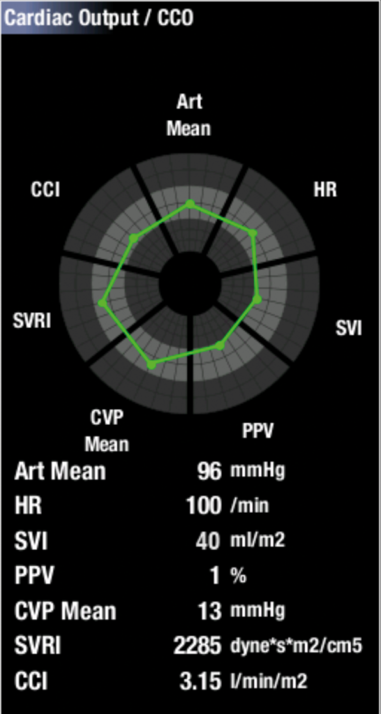 PiCCO graphical view on a CARESCAPE monitor