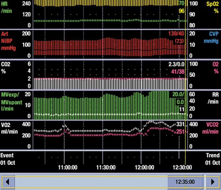 Screen displaying an acute increase in ventilatory demand