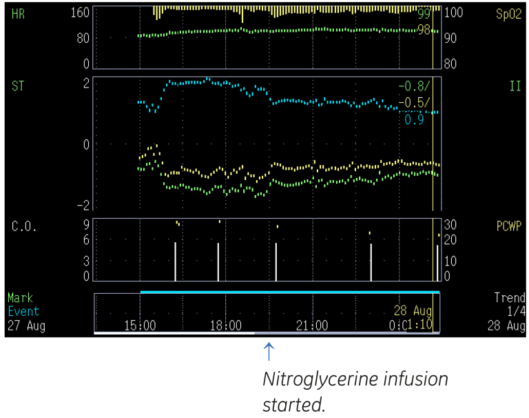 Screen showing when did Nitroglycerine infusion start