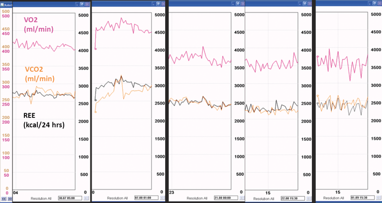 Variation of energy expenditure in a patient that developed severe complications after bariatric surgery