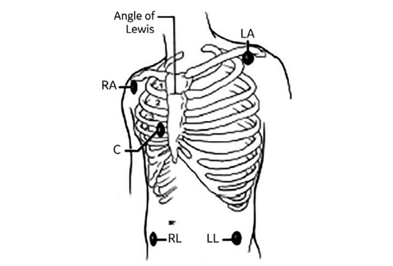 Precordial sites where electrodes can be placed for monitoring 