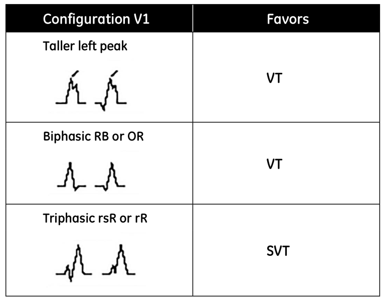 Display of different V1 configurations and the tachycardia they favor