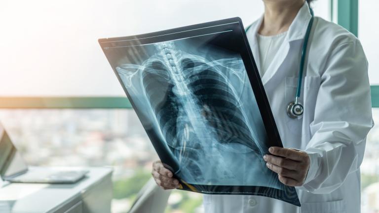 Doctor looking at a Lung X-ray