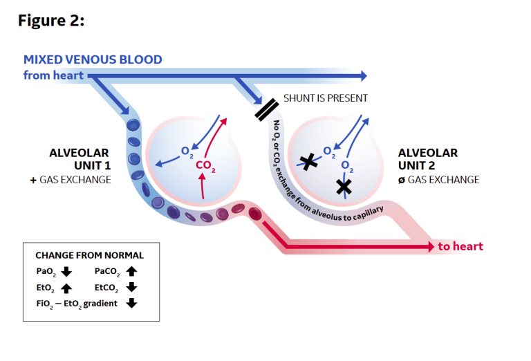 Decrease number of mixed-venous capillaries in gas exchange due to a perfusion shunt