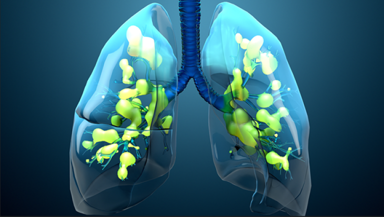 Is APRV the Right Mode of Ventilation for ARDS Patients?