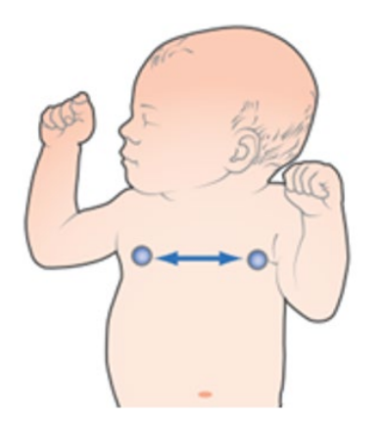 Neonatal patient with lead I placement