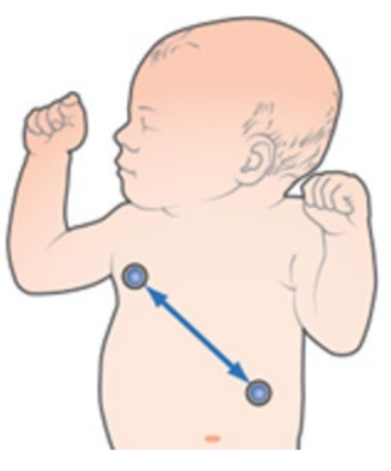 Neonatal patient with lead II placement