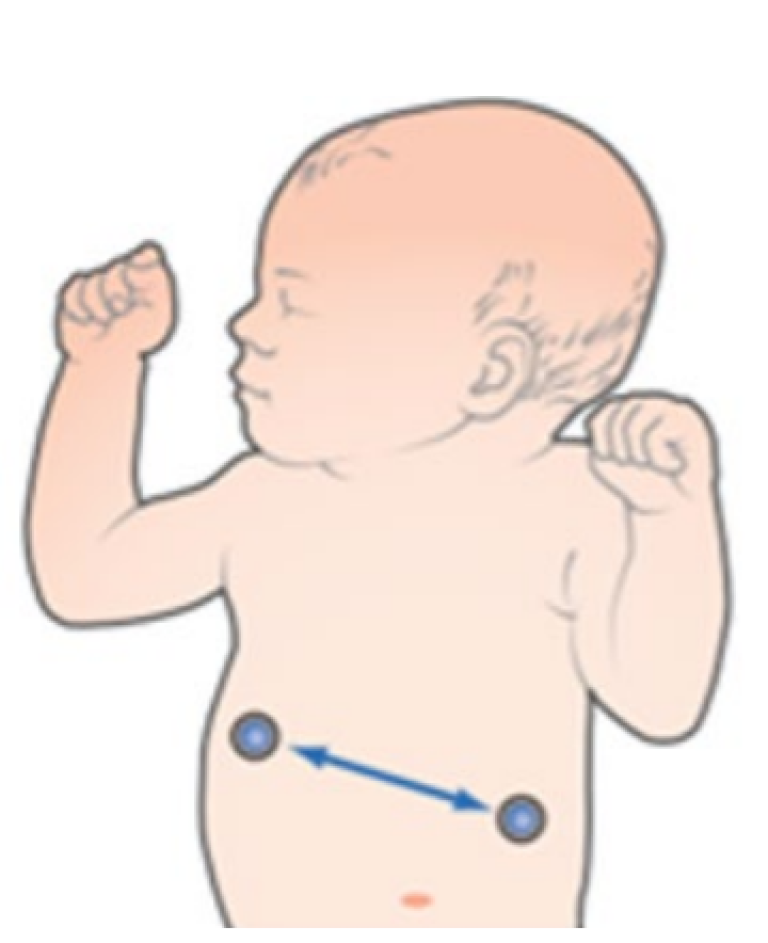 Neonatal patient with vector RL-LL placement