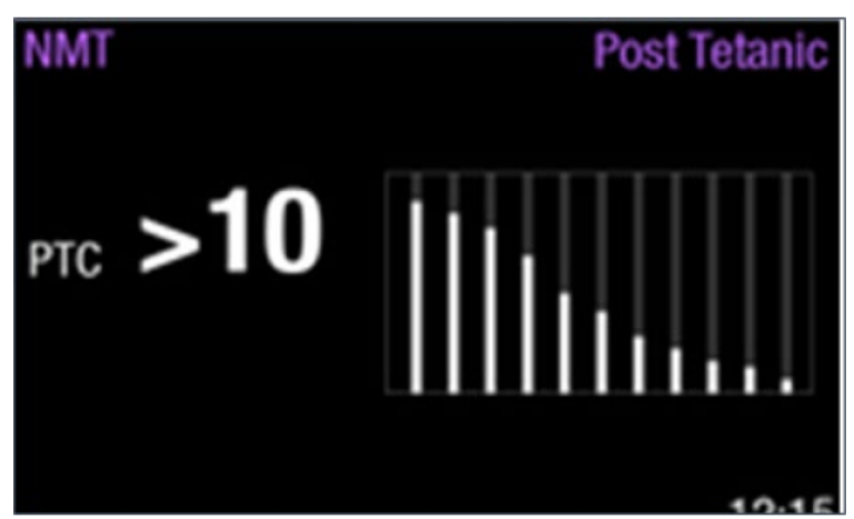 Post-tetanic count