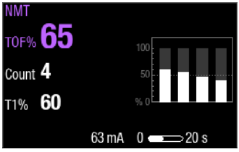 Step 2 to monitor neuromuscular block