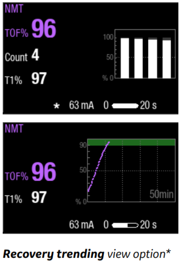 Step 5 to monitor neuromuscular block
