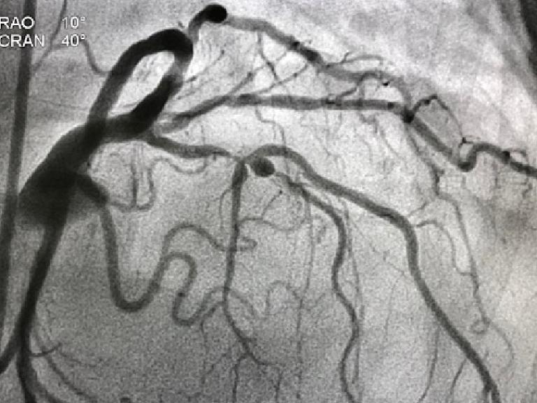 Coronary angiogram