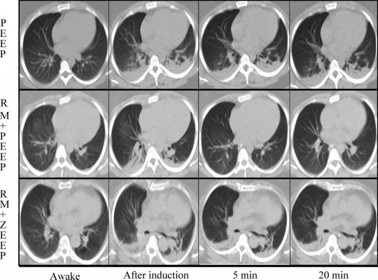 CT lung images