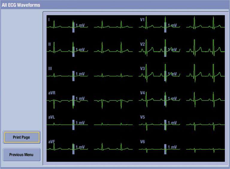 12-lead ECG view