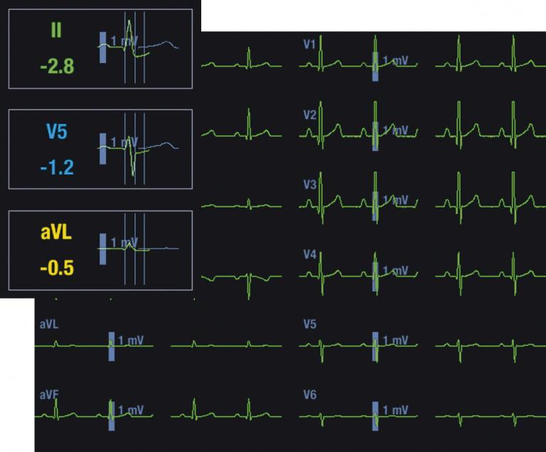 12-lead ST screen