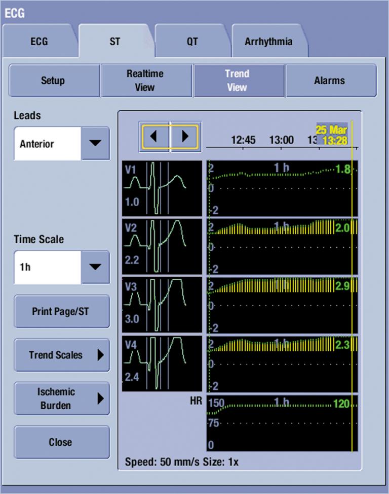 Ischemic burden view