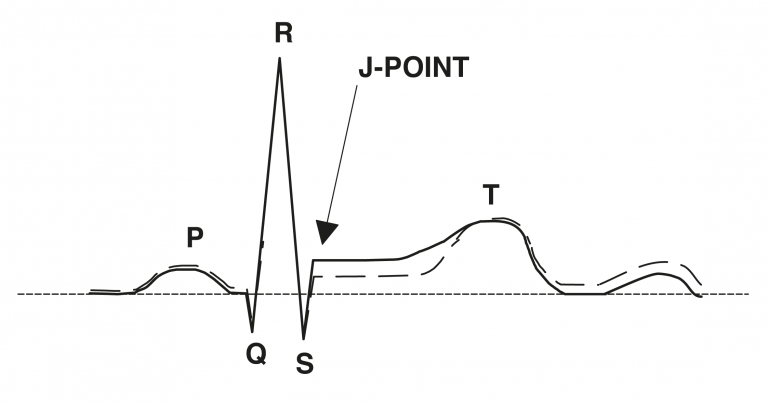 ST-segment indicating ischemia