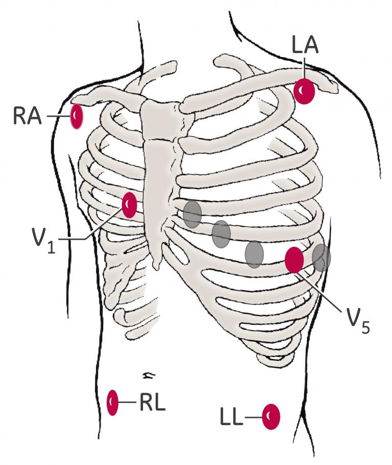 List 99+ Pictures 12-lead Ecg Placement On A Female Latest