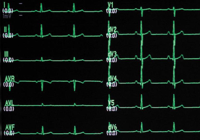 12-lead ECG monitoring screen
