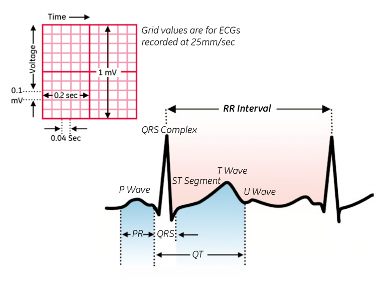 Figure 3. Determination of the QT interval