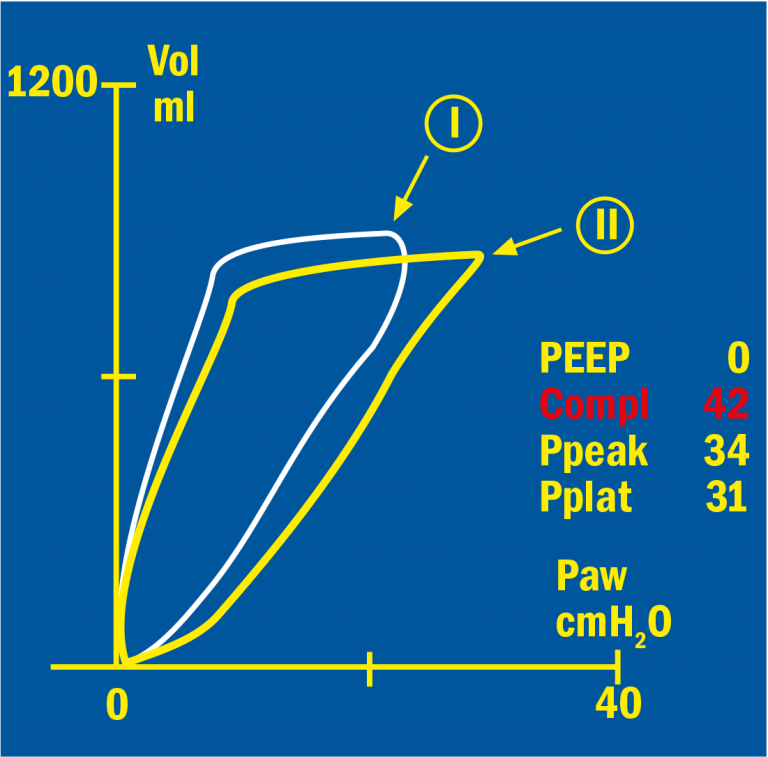 Pressure/Volume loop showing the efficacy of PEEP treatment