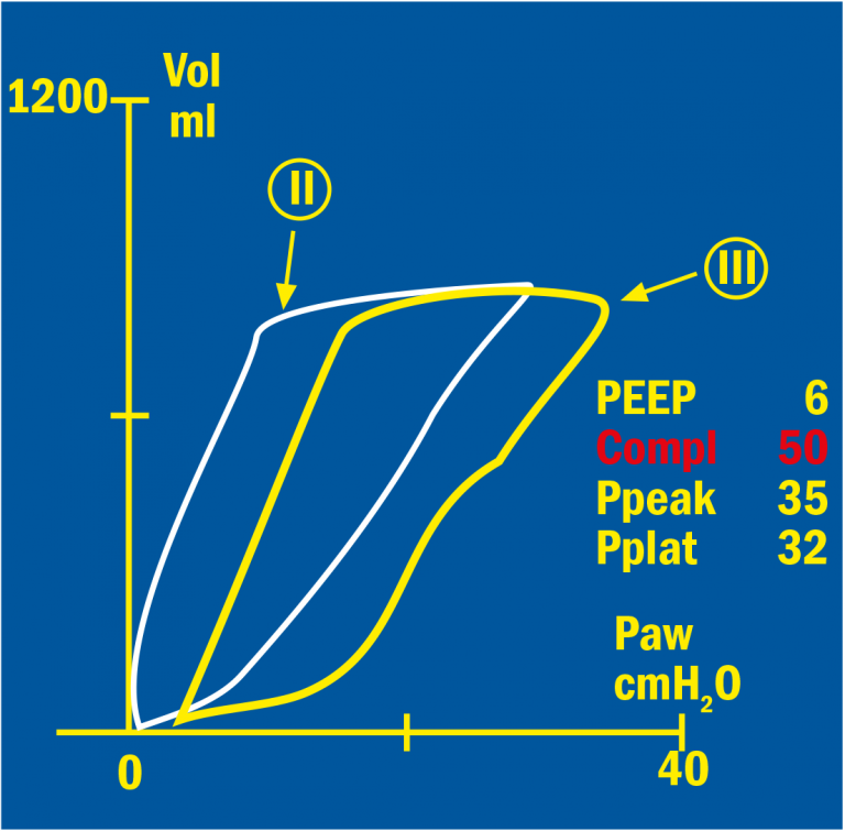 Pressure/Volume loop of the efficacy of PEEP treatment