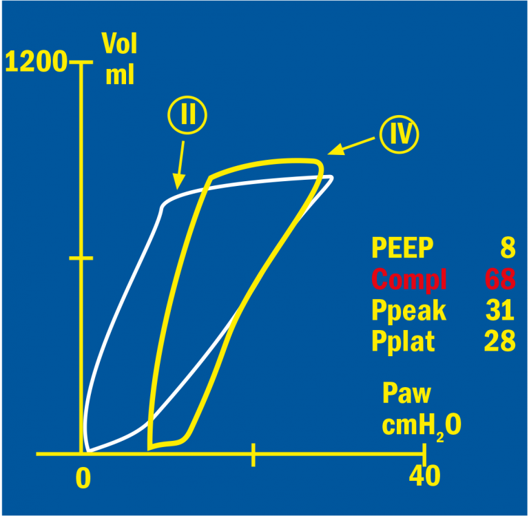 Pressure/Volume loop of the efficacy of PEEP treatment