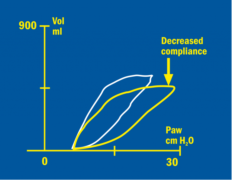 Bronchospasm Pressure/Volume loop