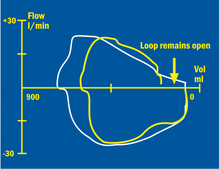 Volume/Flow loop of a cuff or laryngeal mask leak