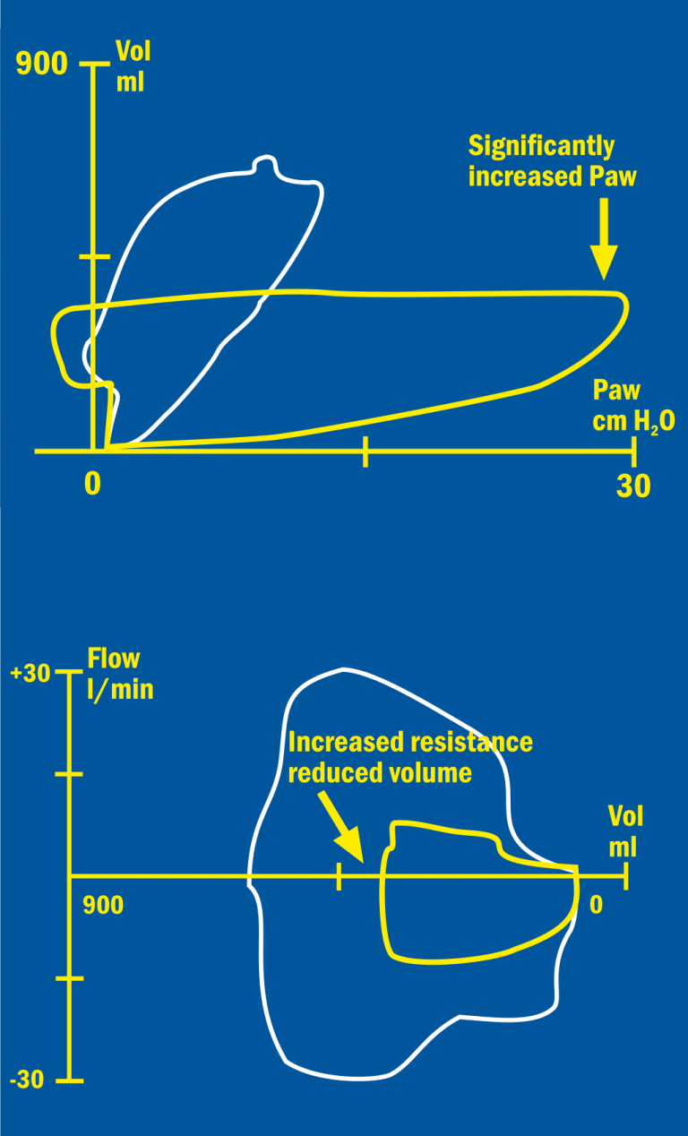 Kinked endotracheal tube Pressure/Volume loop