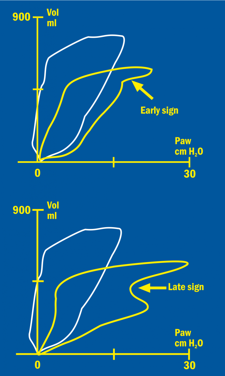 Volume/Pressure loop of a patient breathing against ventilator