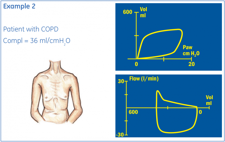 Patient with CCPD Pressure/Volume and Flow/Volume loop example
