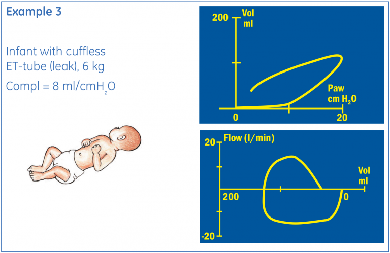 Example of an infant Pressure/Flow and Volume/Flow loop