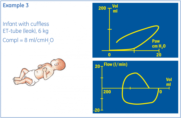 Patient Spirometry: Viewing Ventilation Status | Clinical View