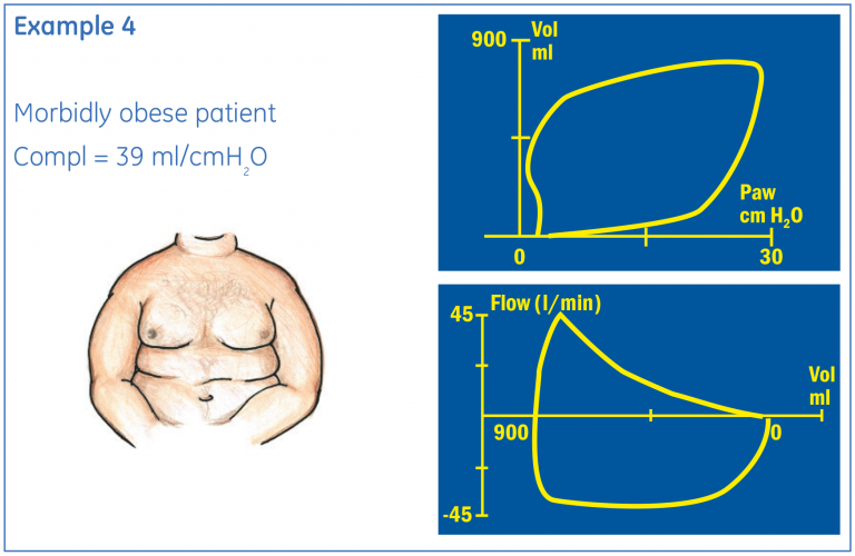 Example of the Pressure/Volume and Volume/Flow of a morbid obese patient