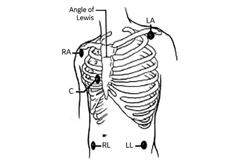 Precordial sites where electrodes can be placed for monitoring