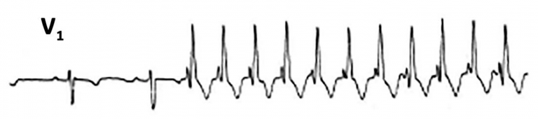 Onset of wide QRS complex tachycardia recorded in lead V1 showing a triphasic rsR pattern