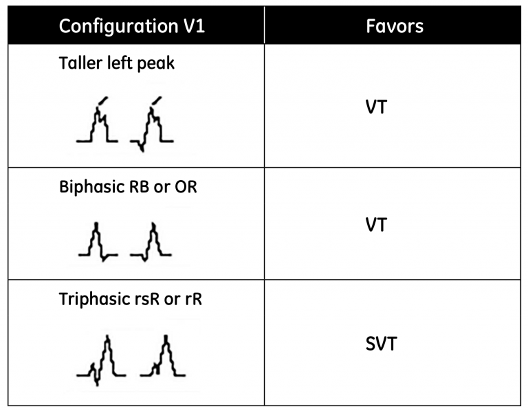 Display of different V1 configurations and the tachycardia they favor