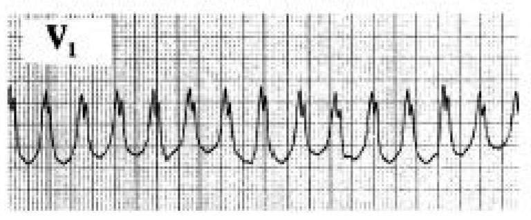 V1 lead showing an upright QRS complex, indicating a diagnosis of VT.