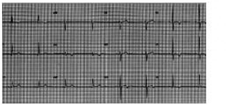 Standard 12-lead ECG showing Mr. M.’s normal ST segments recorded prior to an ischemic event.