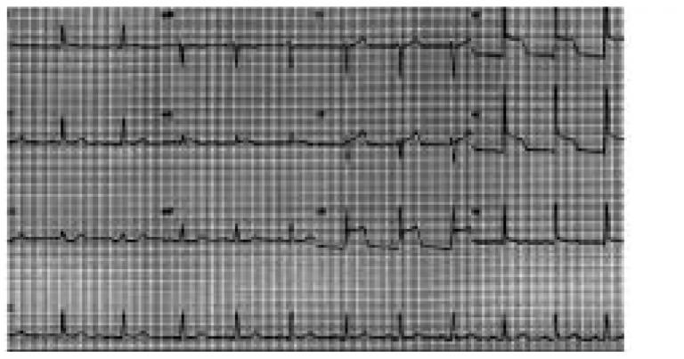 Standard 12-lead ECG recorded minutes later showing ST segment elevation