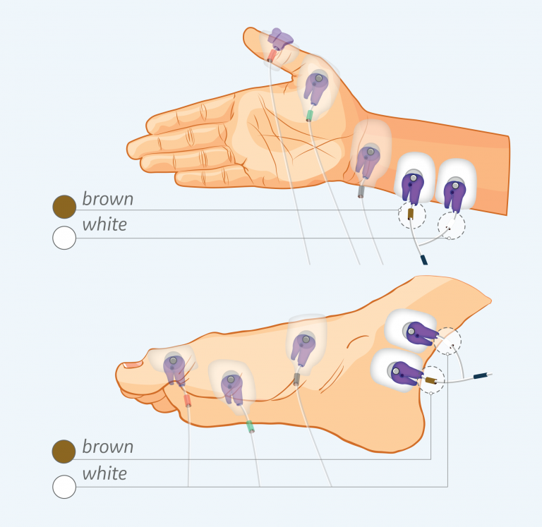 Figure 1. Stimulation electrodes
