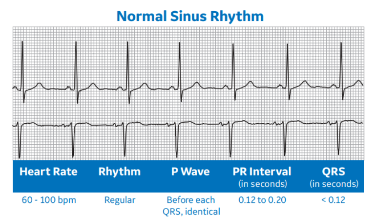 Normal Sinus Rhythm
