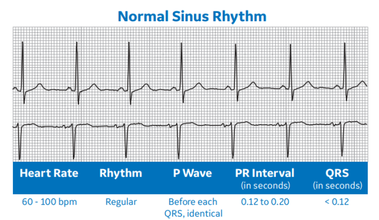 Arrhythmia Recognition Part 1 | Clinical View